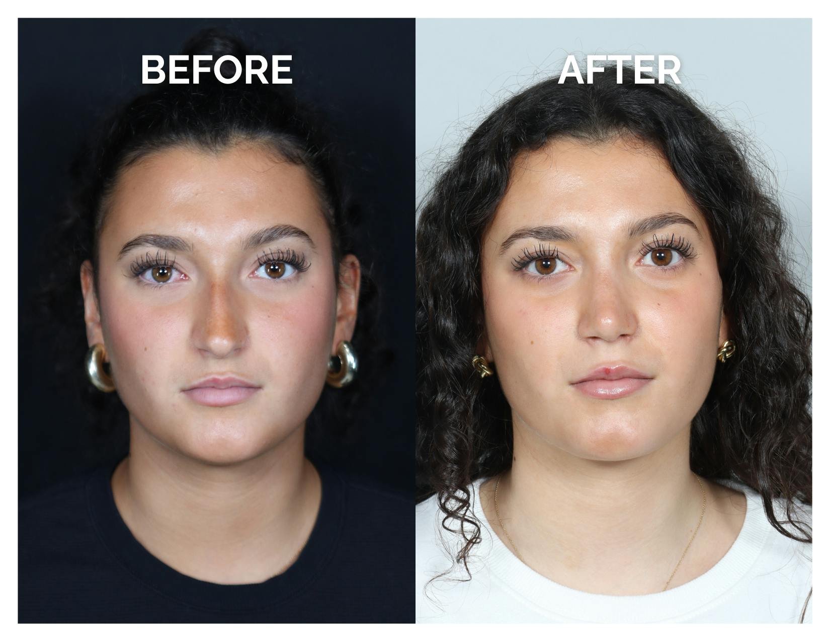 Rhinoplasty Before & After Gallery - Patient 969451 - Image 3