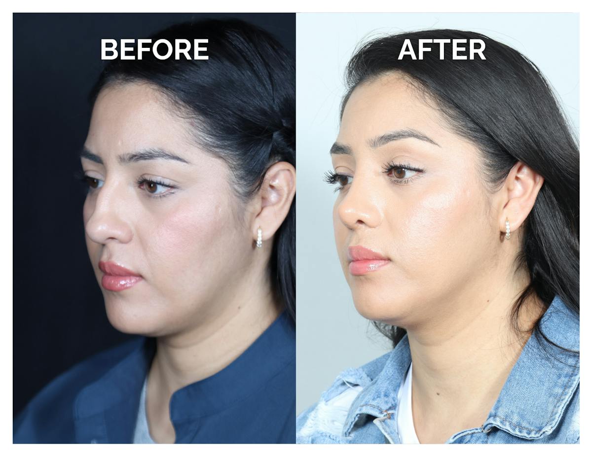 Rhinoplasty Before & After Gallery - Patient 877869 - Image 4