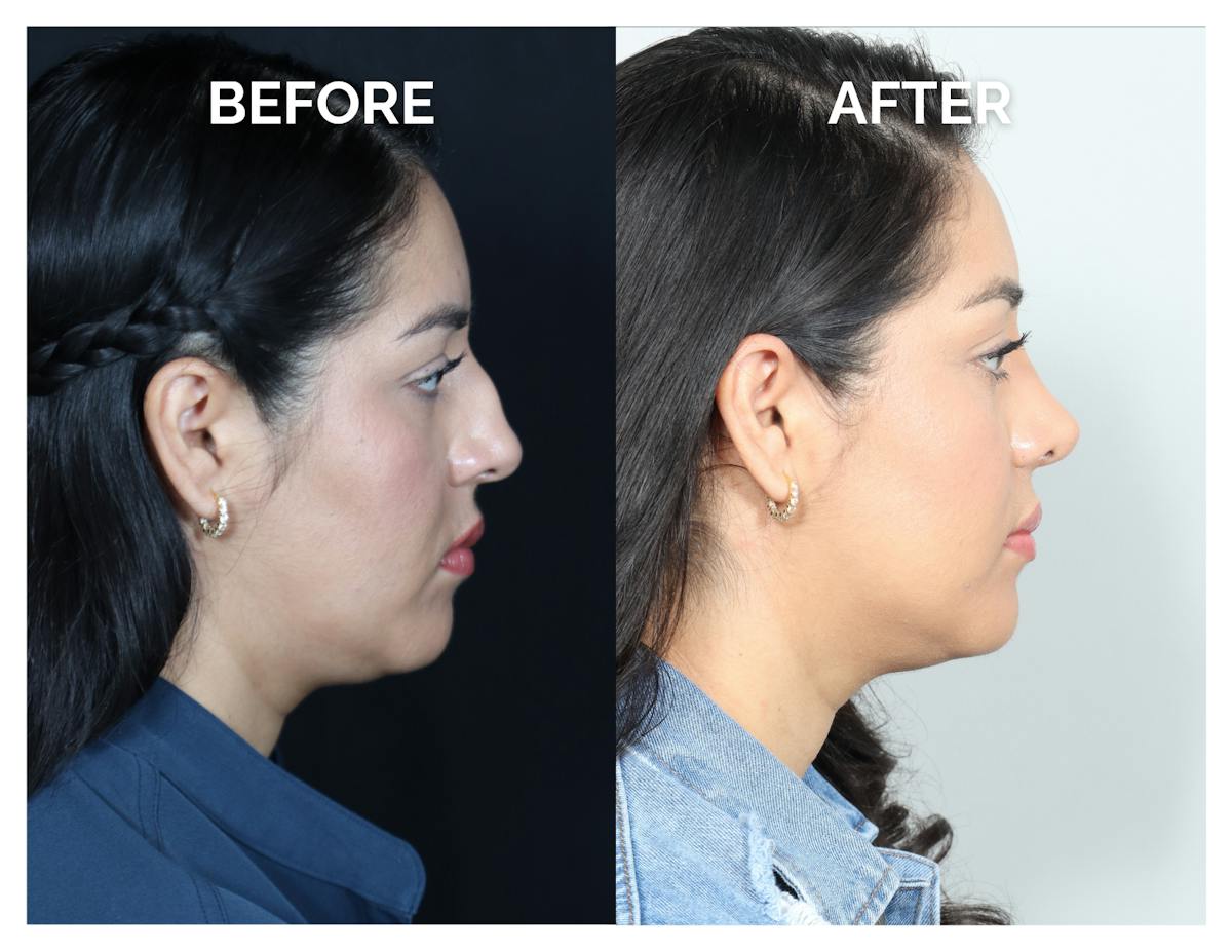 Rhinoplasty Before & After Gallery - Patient 877869 - Image 2