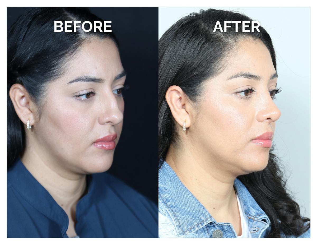 Rhinoplasty Before & After Gallery - Patient 877869 - Image 1