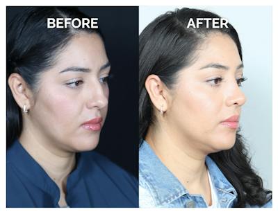 Rhinoplasty Before & After Gallery - Patient 877869 - Image 1