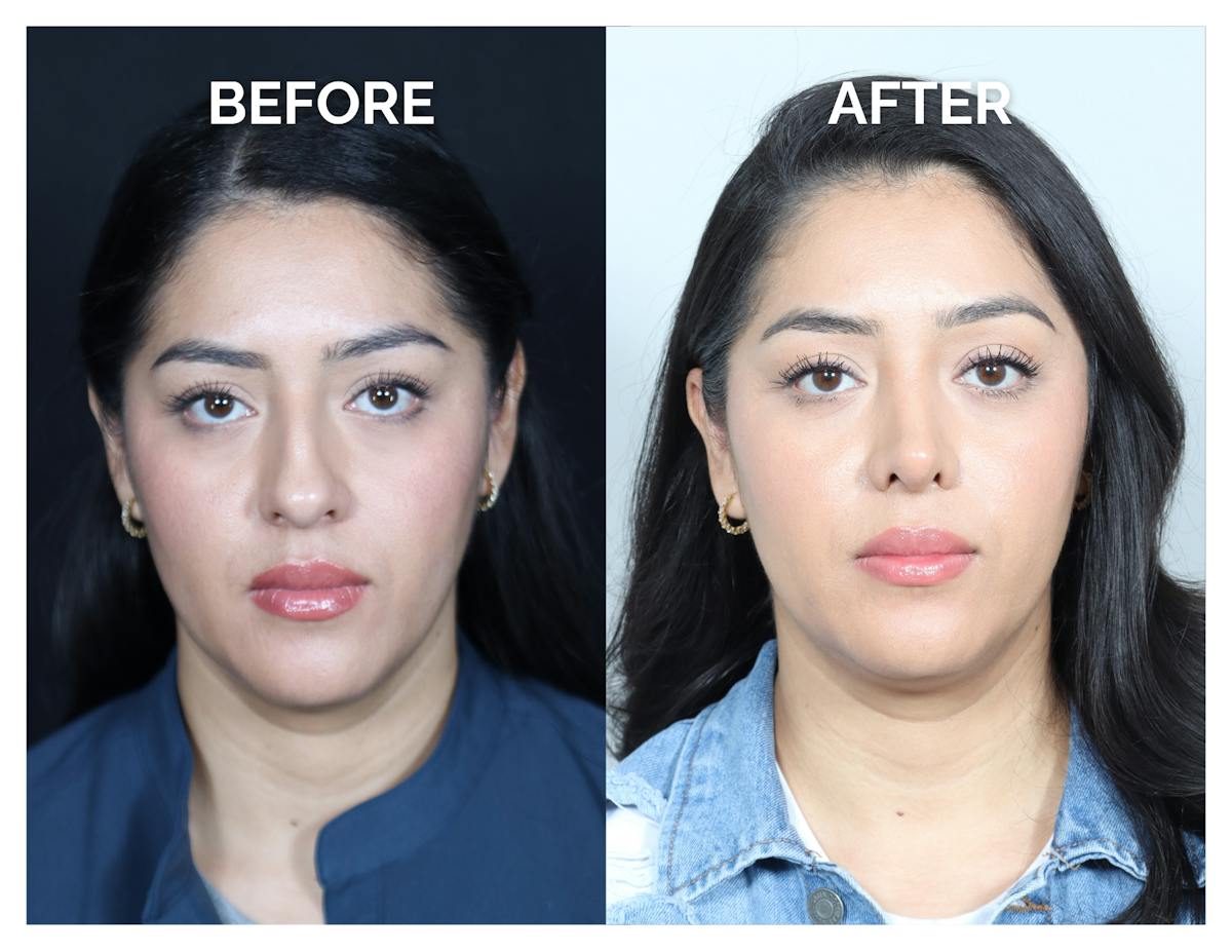 Rhinoplasty Before & After Gallery - Patient 877869 - Image 3