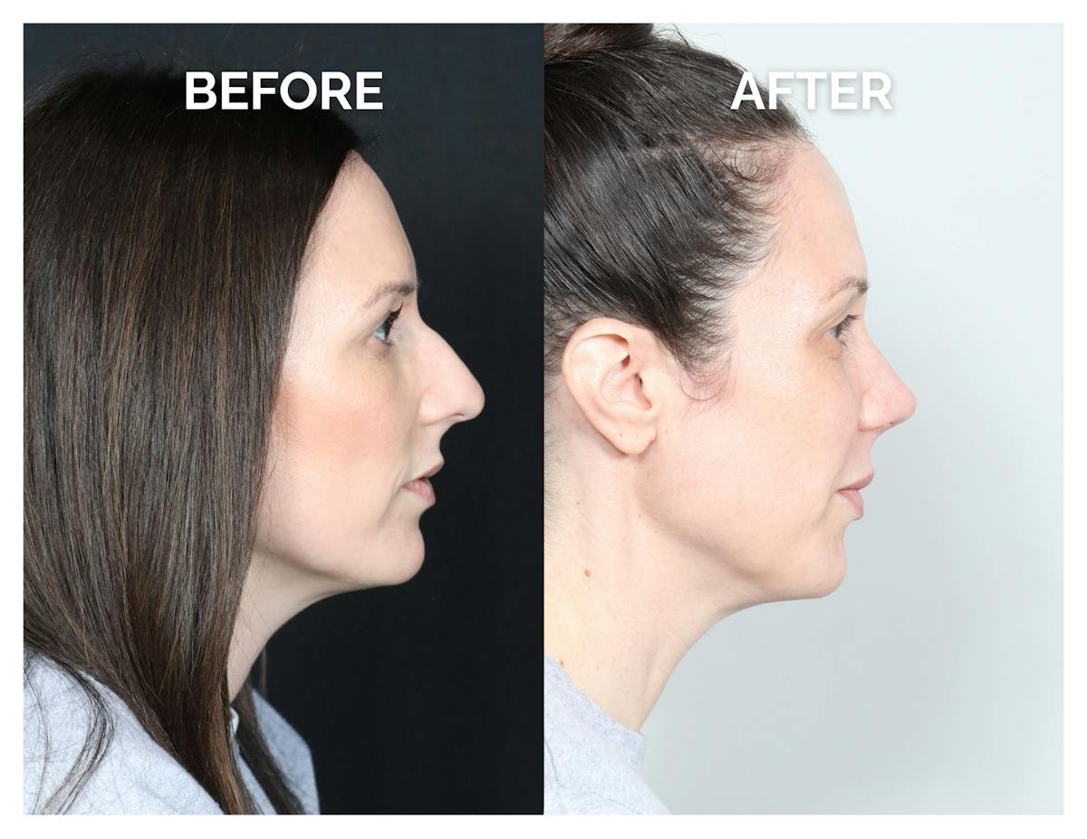 Rhinoplasty Before & After Gallery - Patient 415360 - Image 3