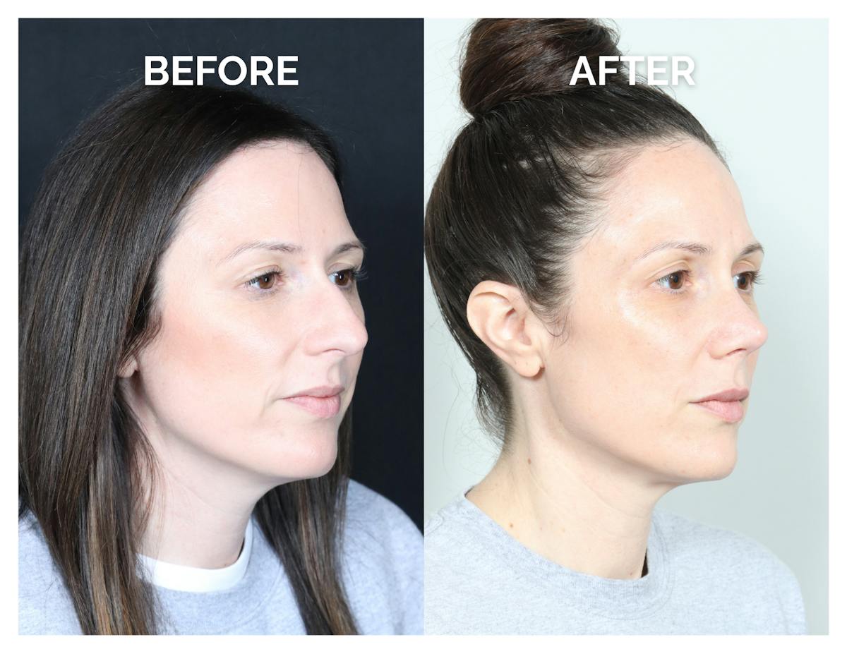 Rhinoplasty Before & After Gallery - Patient 415360 - Image 1