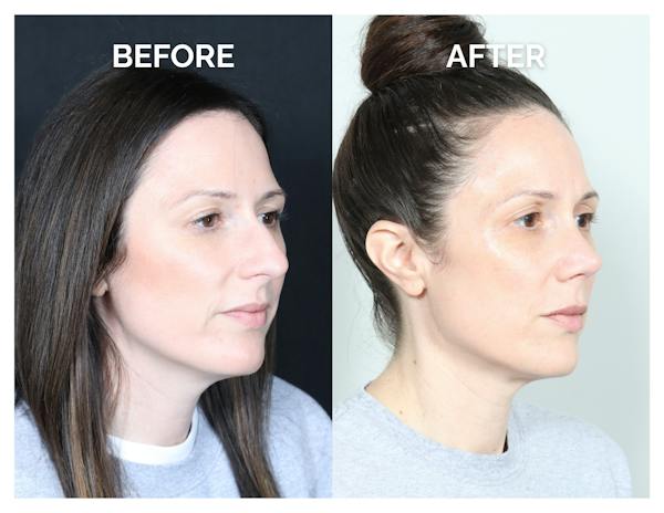 Rhinoplasty Before & After Gallery - Patient 415360 - Image 1