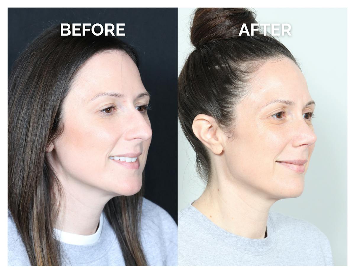 Rhinoplasty Before & After Gallery - Patient 415360 - Image 2