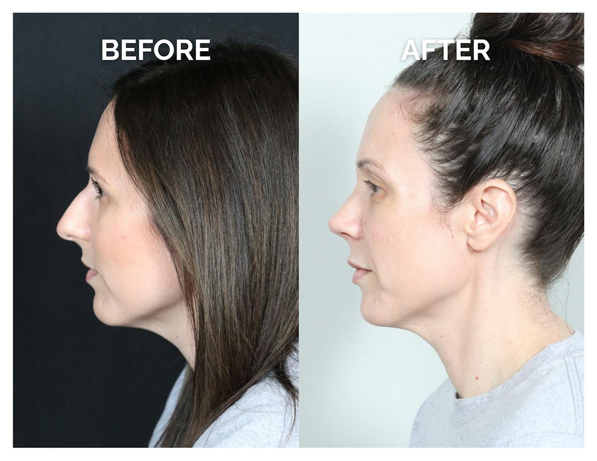 Rhinoplasty Before & After Gallery - Patient 415360 - Image 4