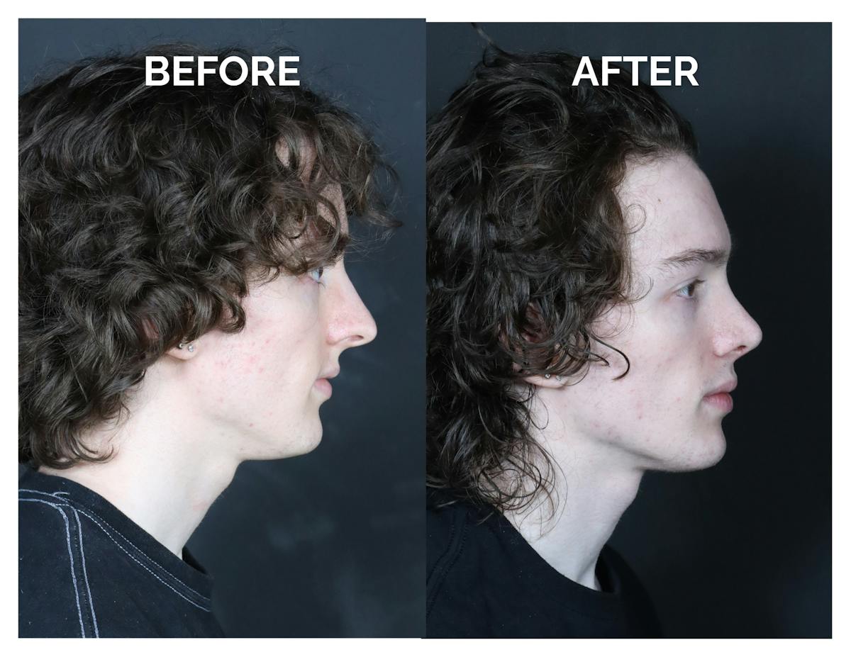 Rhinoplasty Before & After Gallery - Patient 328479 - Image 2