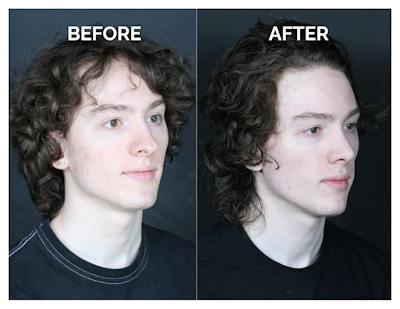 Rhinoplasty Before & After Gallery - Patient 328479 - Image 1