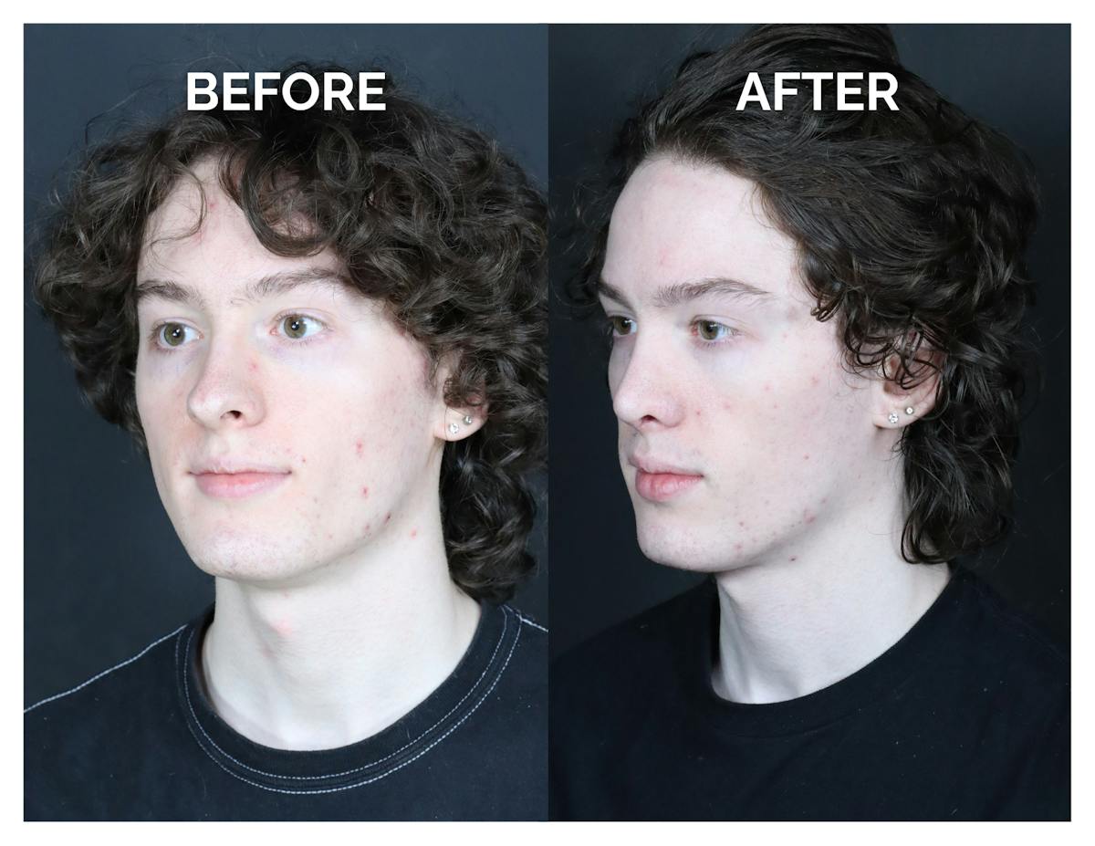 Rhinoplasty Before & After Gallery - Patient 328479 - Image 4
