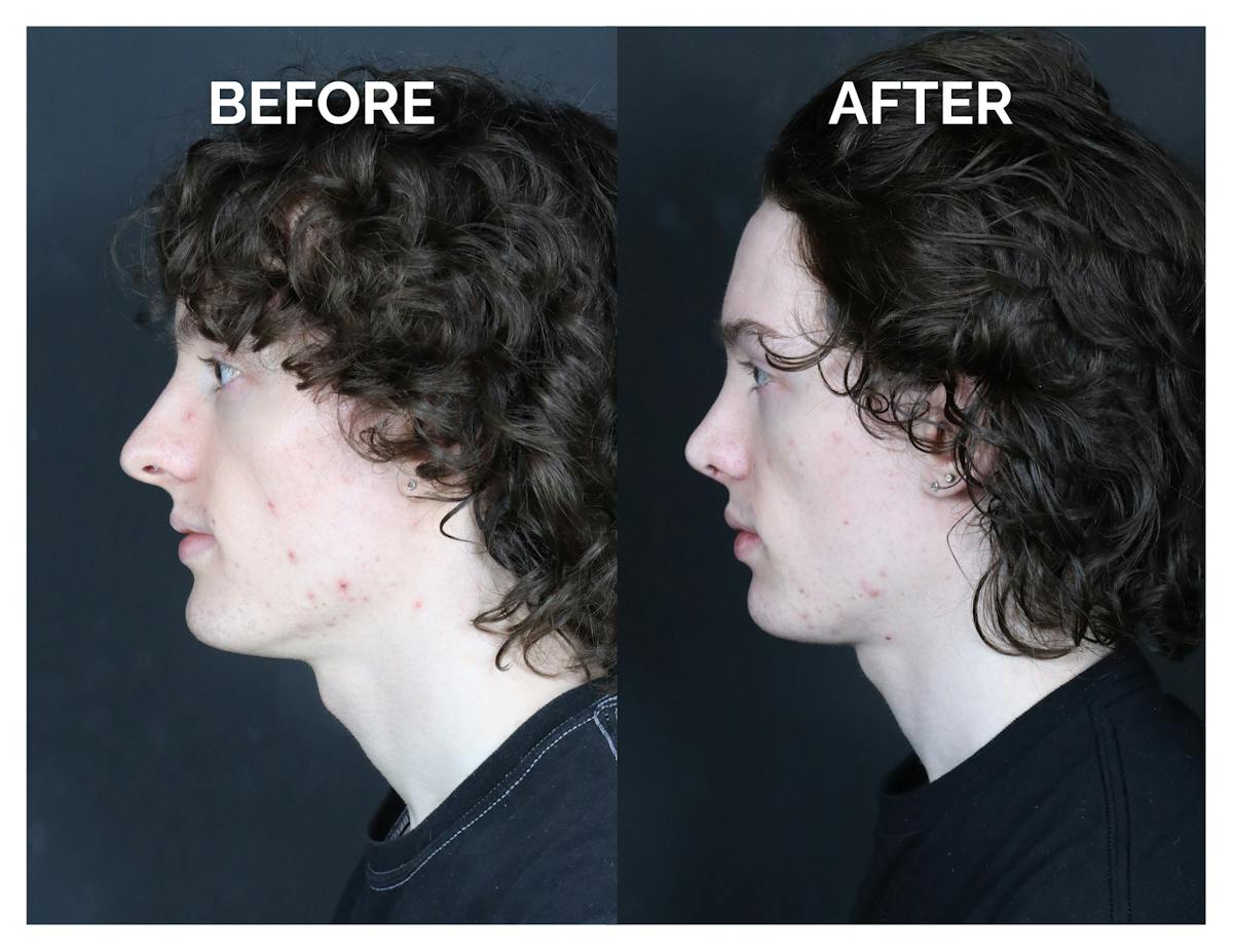 Rhinoplasty Before & After Gallery - Patient 328479 - Image 3