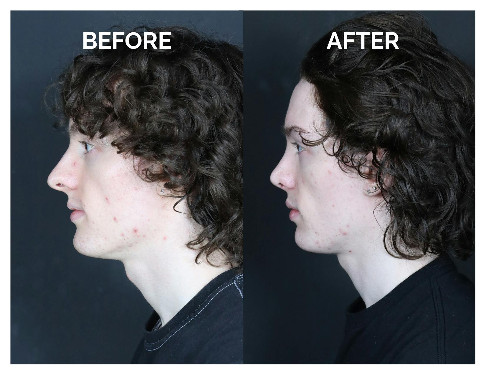 Rhinoplasty Before & After Gallery - Patient 328479 - Image 3