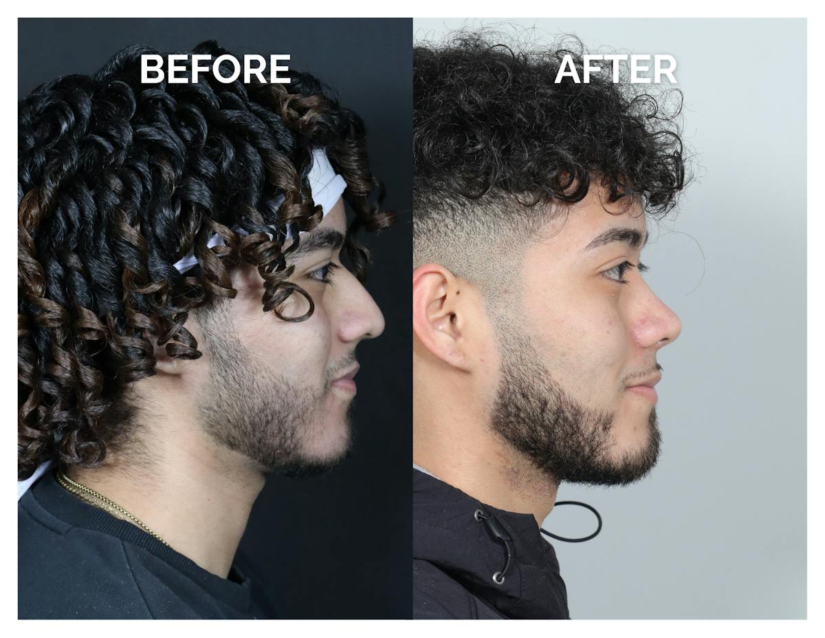 Rhinoplasty Before & After Gallery - Patient 579082 - Image 3