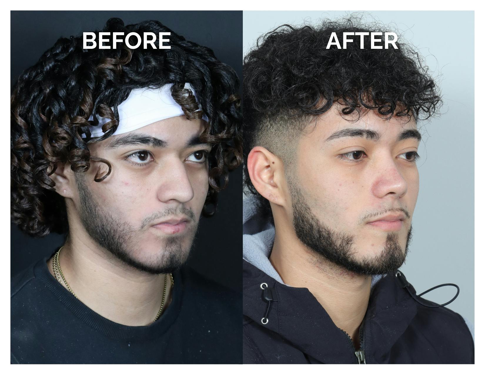Rhinoplasty Before & After Gallery - Patient 579082 - Image 2