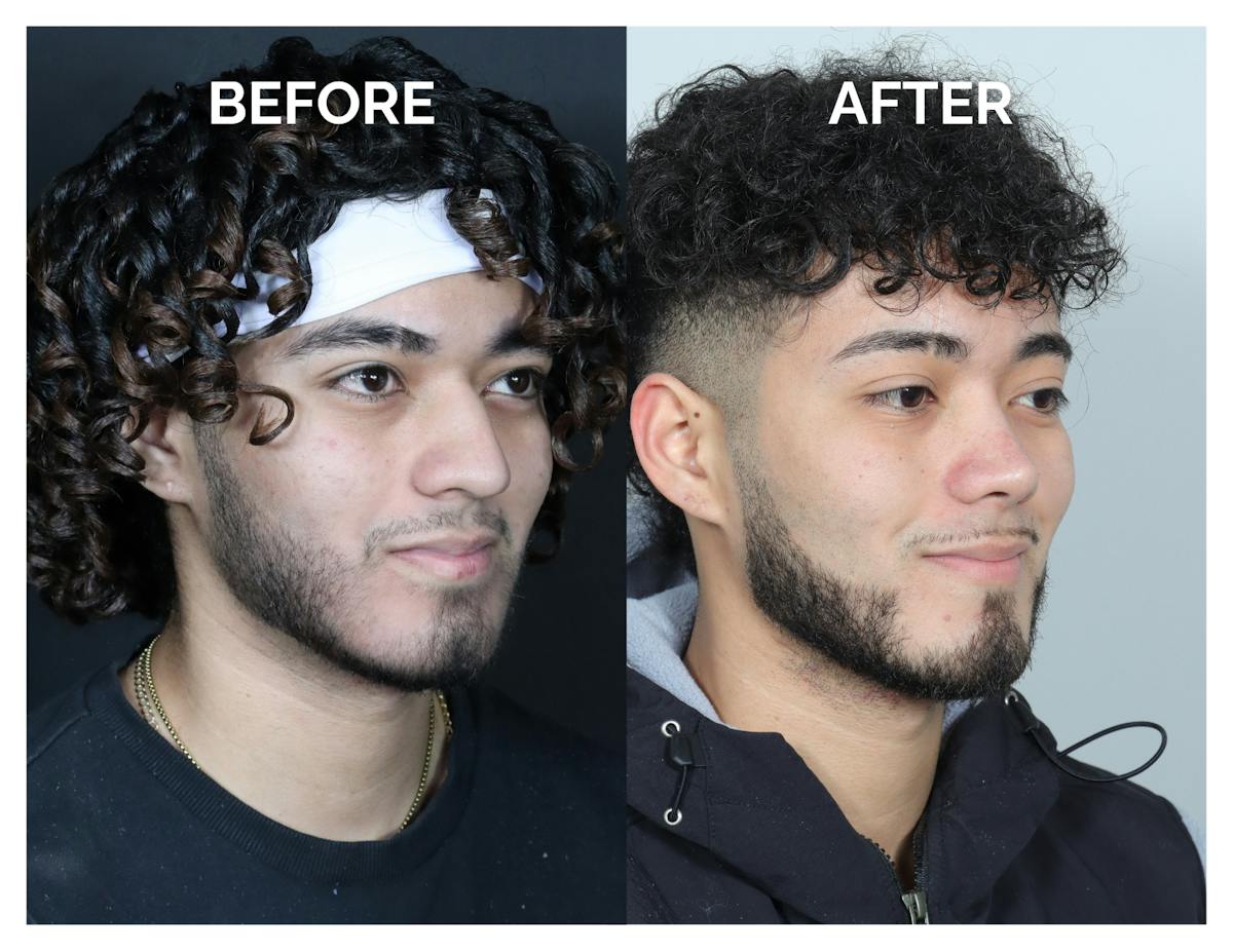 Rhinoplasty Before & After Gallery - Patient 579082 - Image 1