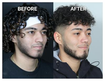 Rhinoplasty Before & After Gallery - Patient 579082 - Image 1