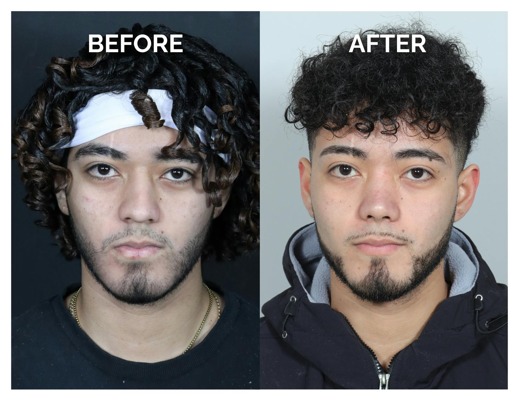 Rhinoplasty Before & After Gallery - Patient 579082 - Image 5