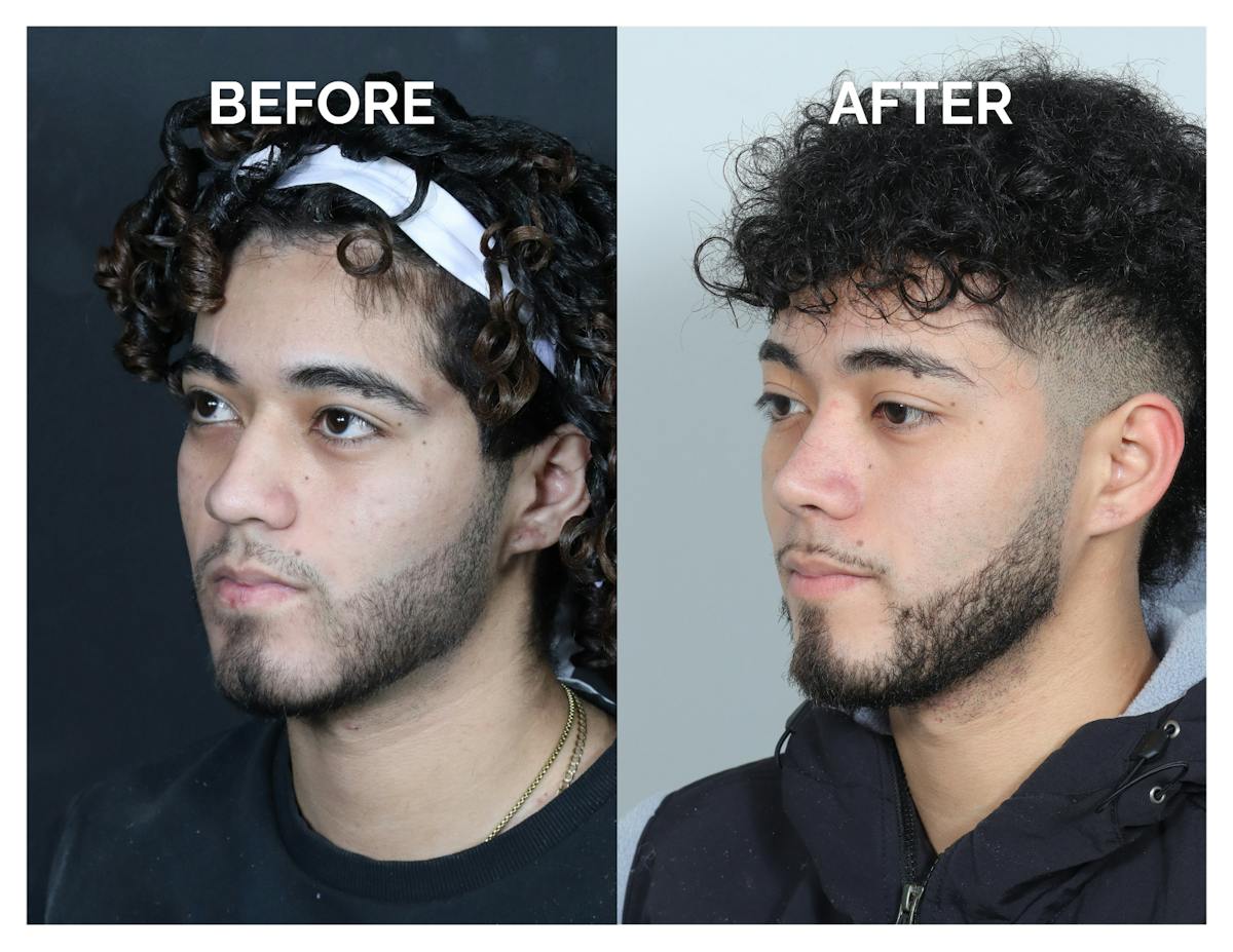 Rhinoplasty Before & After Gallery - Patient 579082 - Image 6