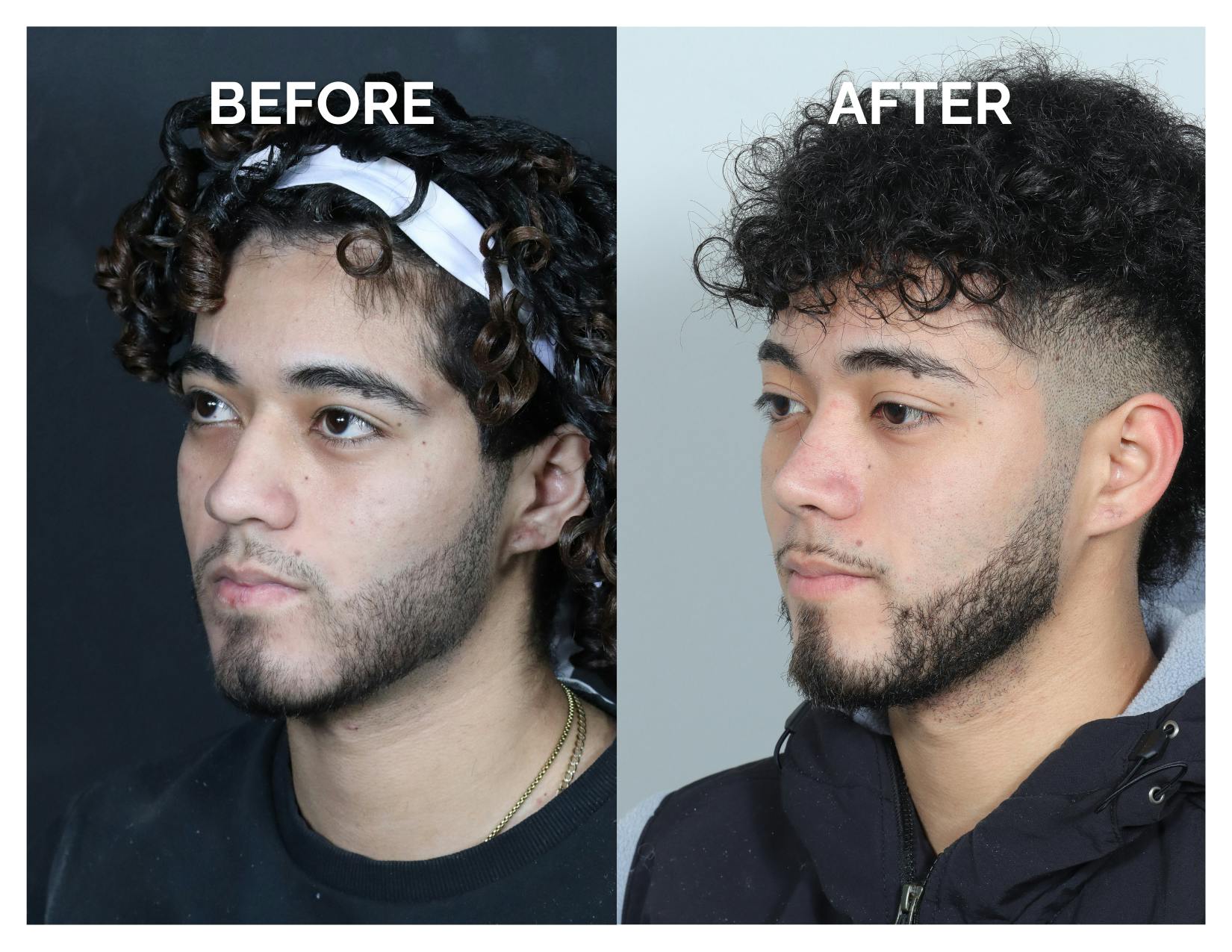 Rhinoplasty Before & After Gallery - Patient 579082 - Image 6