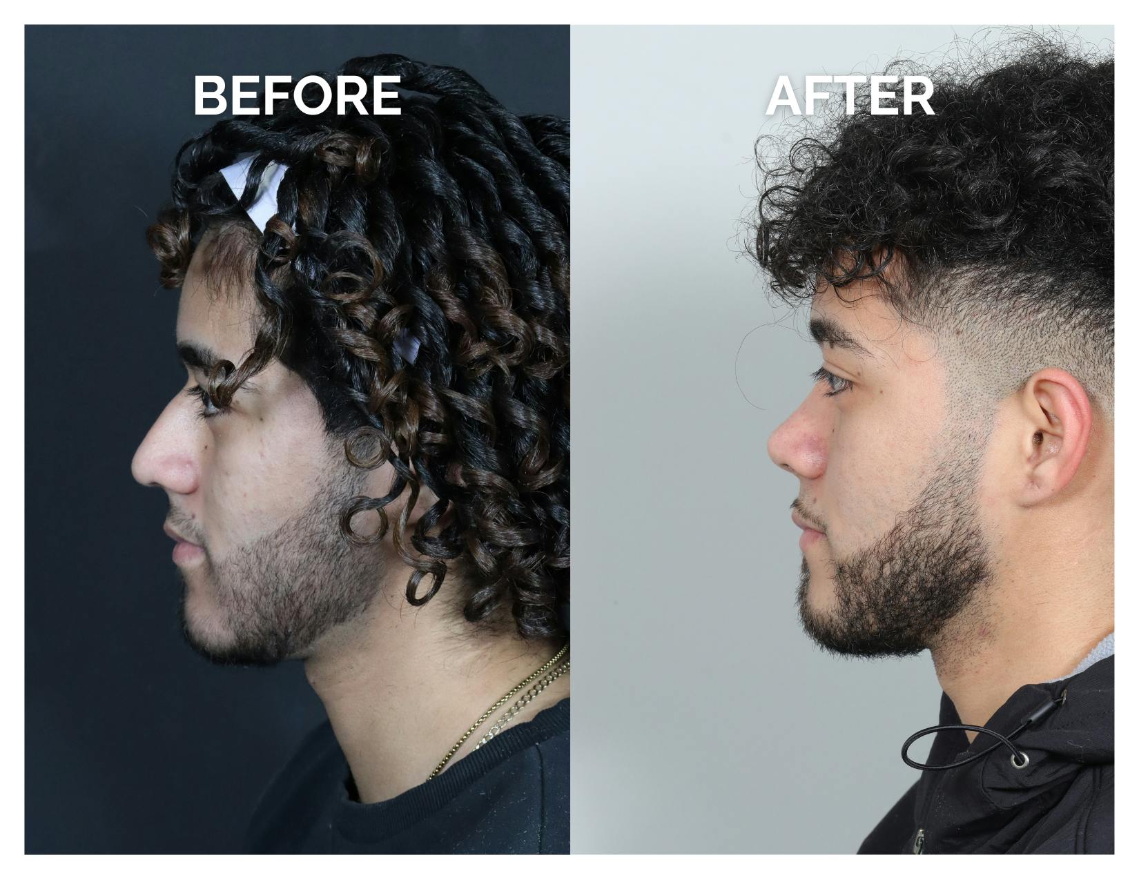 Rhinoplasty Before & After Gallery - Patient 579082 - Image 7