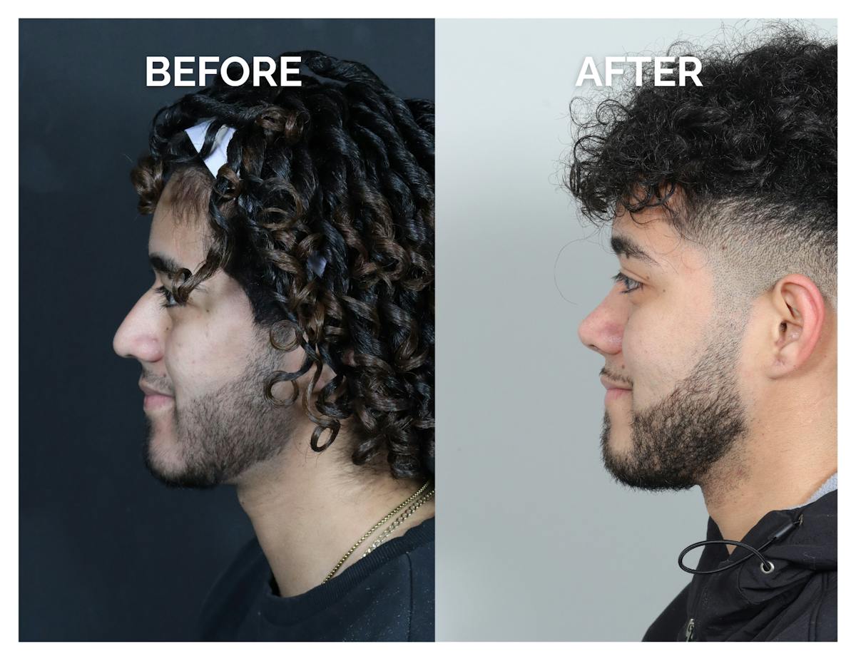 Rhinoplasty Before & After Gallery - Patient 579082 - Image 8