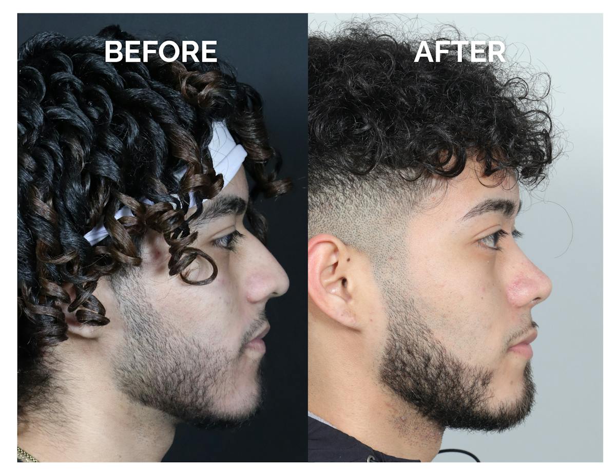 Rhinoplasty Before & After Gallery - Patient 579082 - Image 4