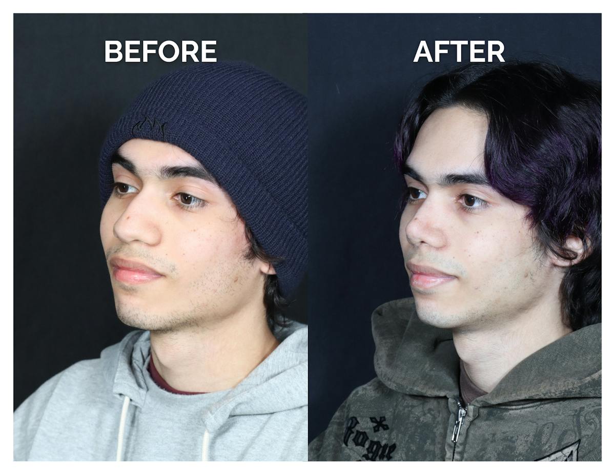 Rhinoplasty Before & After Gallery - Patient 397181 - Image 3