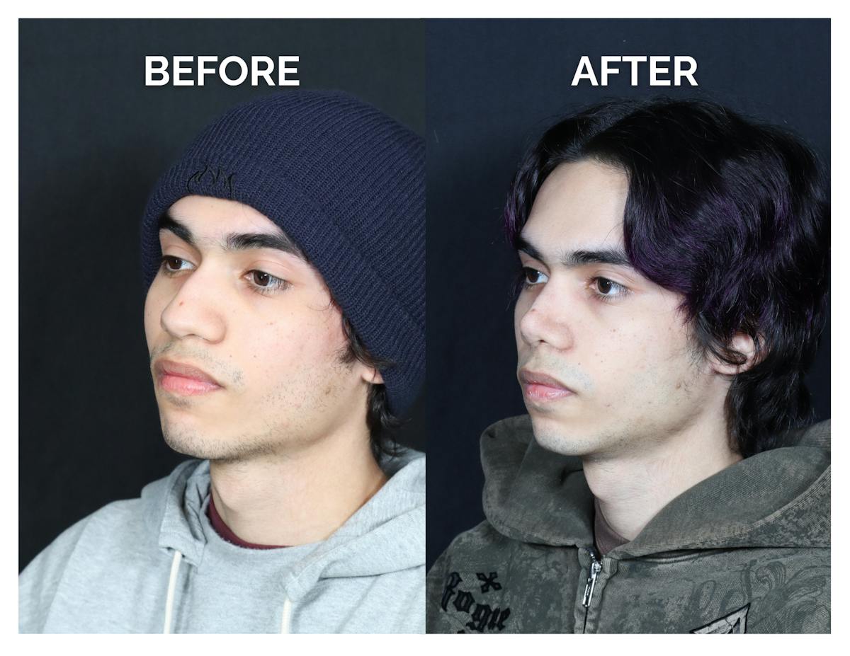 Rhinoplasty Before & After Gallery - Patient 397181 - Image 4