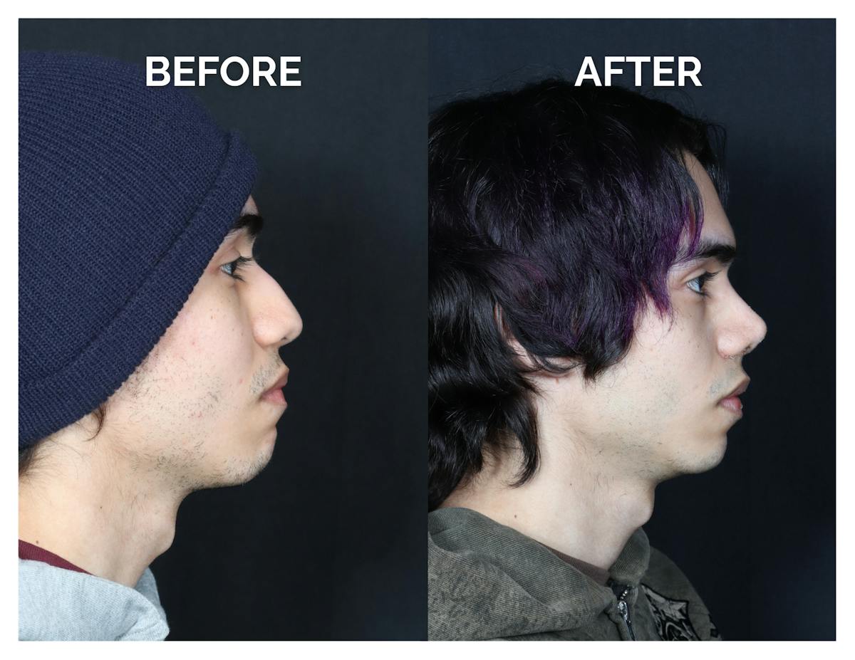 Rhinoplasty Before & After Gallery - Patient 397181 - Image 2