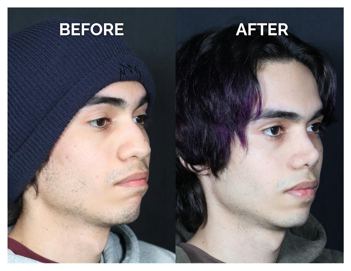 Rhinoplasty Before & After Gallery - Patient 397181 - Image 1