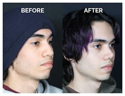 Rhinoplasty Before & After Gallery - Patient 397181 - Image 1