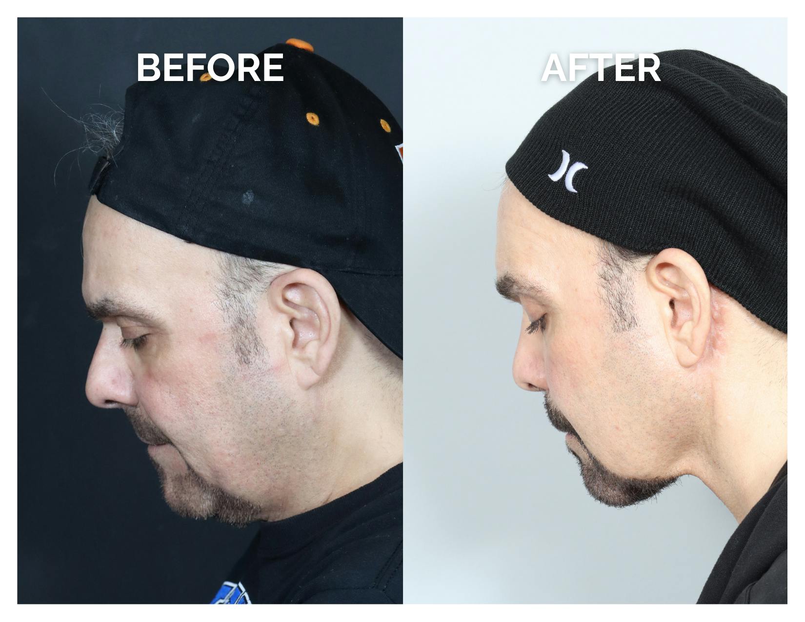 Rhinoplasty Before & After Gallery - Patient 385393 - Image 2
