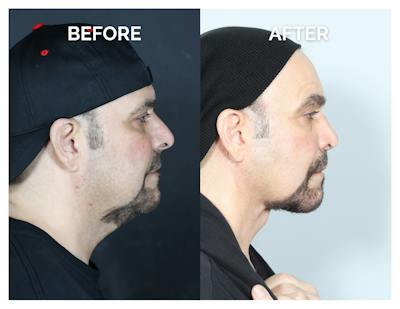 Rhinoplasty Before & After Gallery - Patient 385393 - Image 1