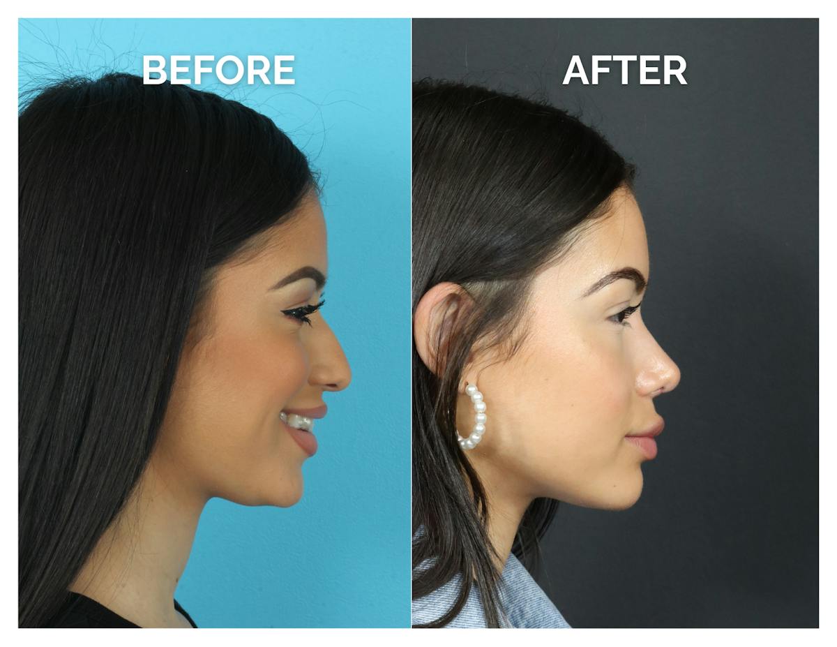 Rhinoplasty Before & After Gallery - Patient 409214 - Image 2