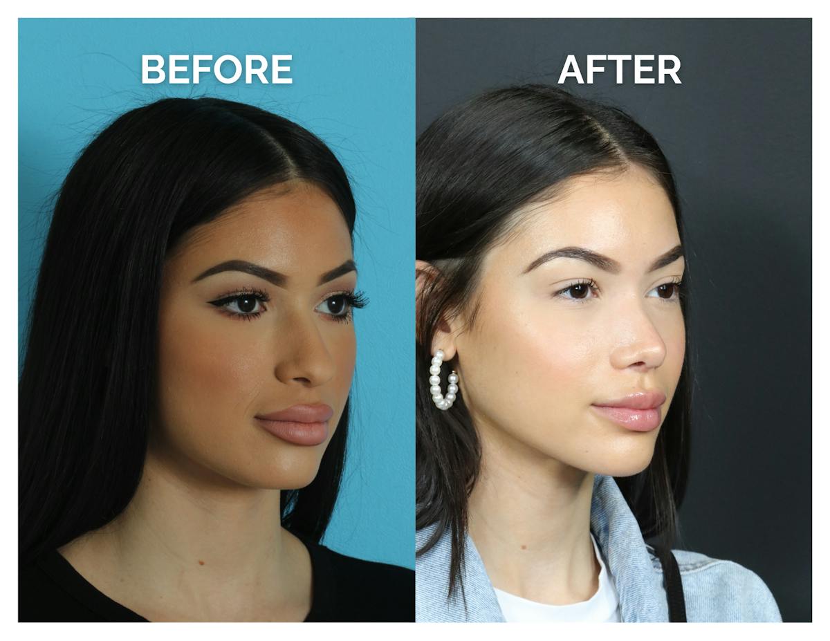 Rhinoplasty Before & After Gallery - Patient 409214 - Image 1