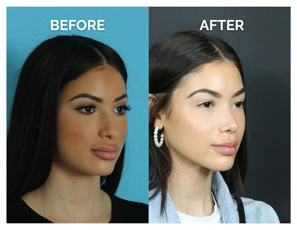 Rhinoplasty Before & After Gallery - Patient 409214 - Image 1
