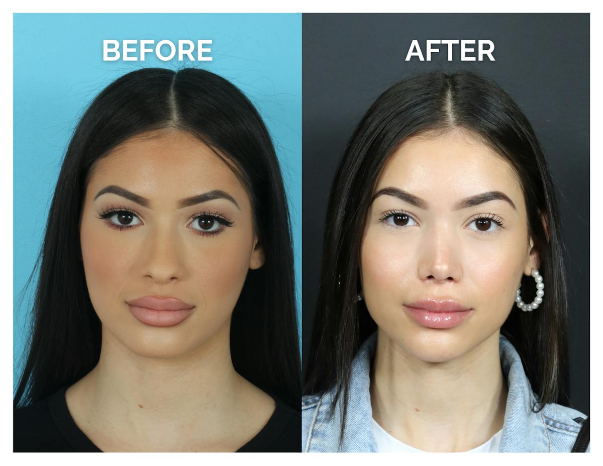 Rhinoplasty Before & After Gallery - Patient 409214 - Image 3