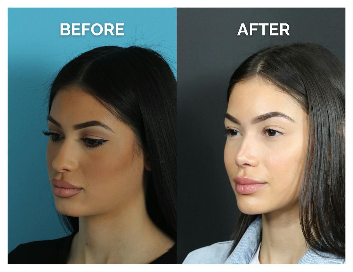 Rhinoplasty Before & After Gallery - Patient 409214 - Image 4