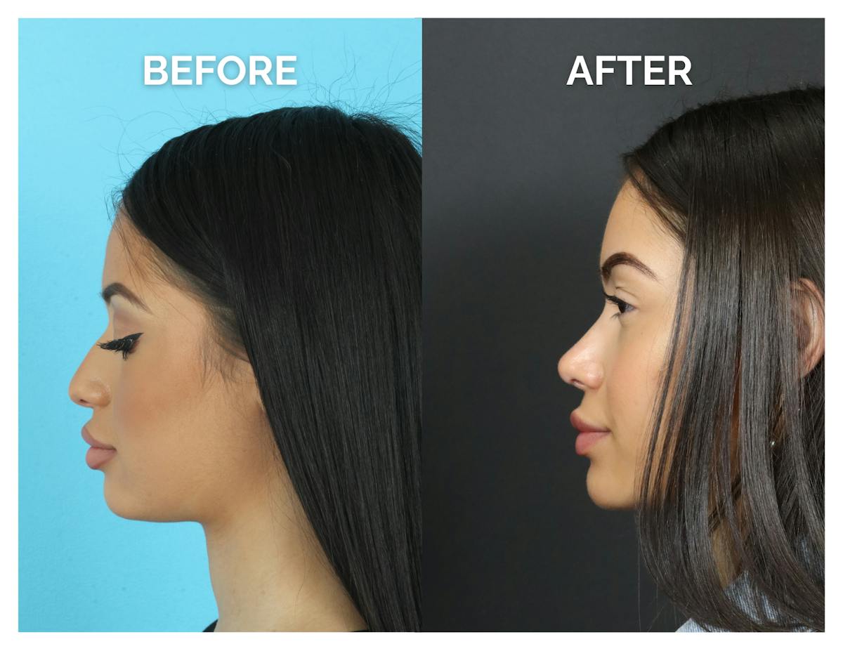 Rhinoplasty Before & After Gallery - Patient 409214 - Image 5