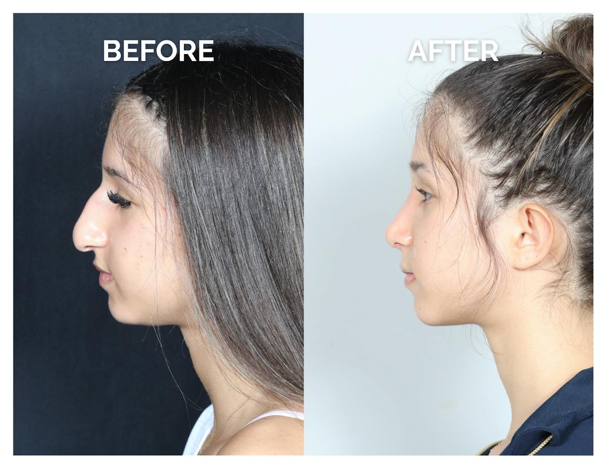 Rhinoplasty Before & After Gallery - Patient 177742 - Image 2
