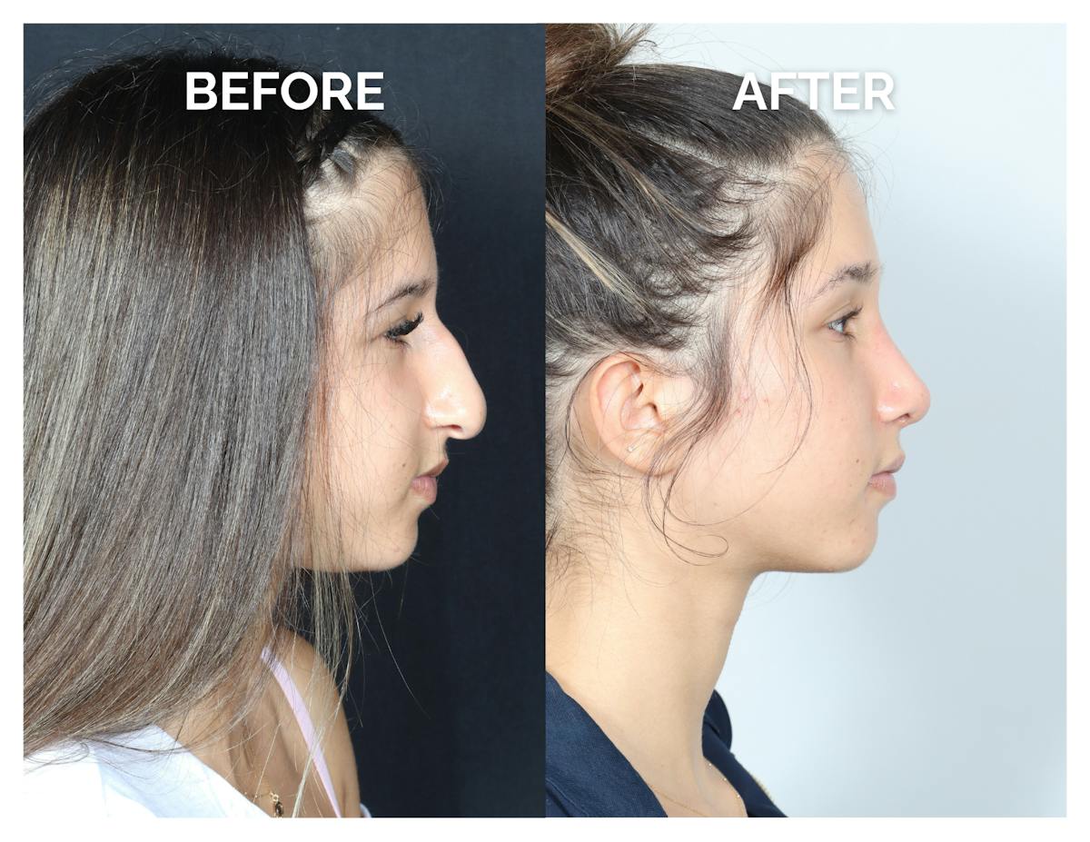 Rhinoplasty Before & After Gallery - Patient 177742 - Image 4