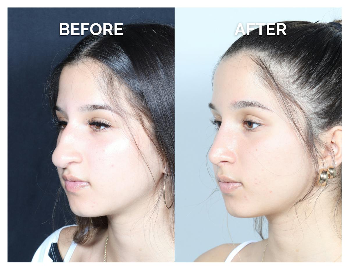 Rhinoplasty Before & After Gallery - Patient 177742 - Image 1