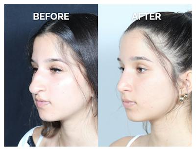 Rhinoplasty Before & After Gallery - Patient 177742 - Image 1