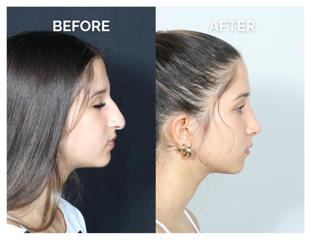 Rhinoplasty Before & After Gallery - Patient 177742 - Image 3