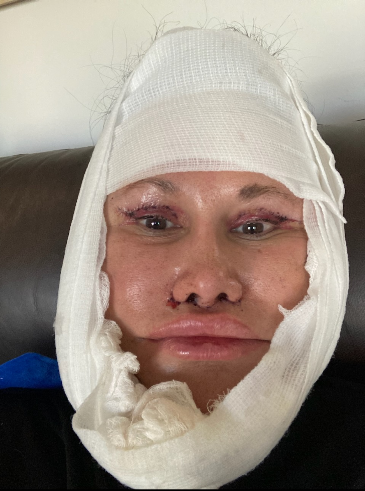 1 Day Post-Op