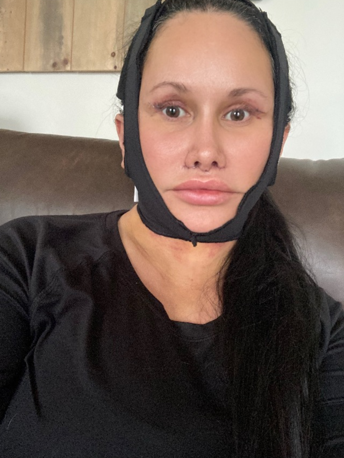 3 Days Post-Op