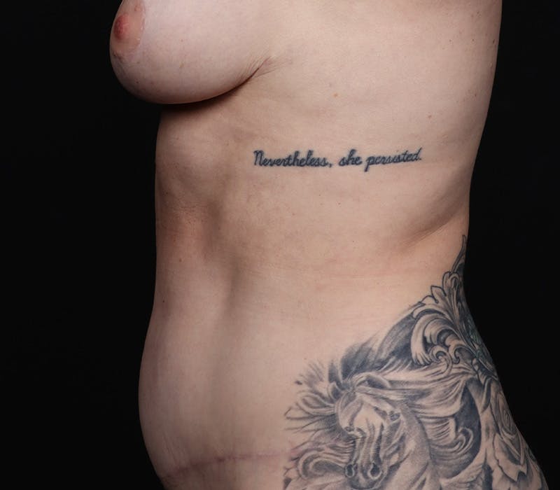 Abdominoplasty Before & After Gallery - Patient 153192 - Image 6