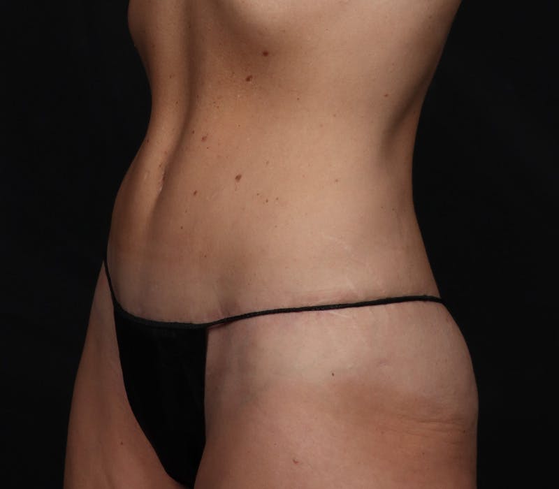 Abdominoplasty Before & After Gallery - Patient 150563 - Image 2
