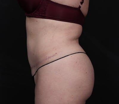 Abdominoplasty Before & After Gallery - Patient 404476 - Image 2