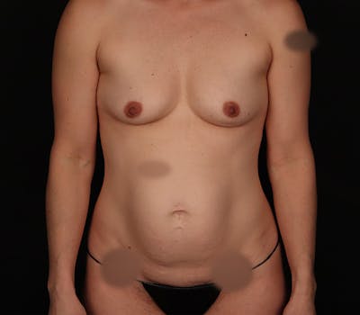 Abdominoplasty Before & After Gallery - Patient 394085 - Image 1